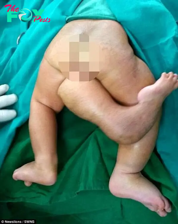 Lạ lùng bé gái sinh ra có 3 chân