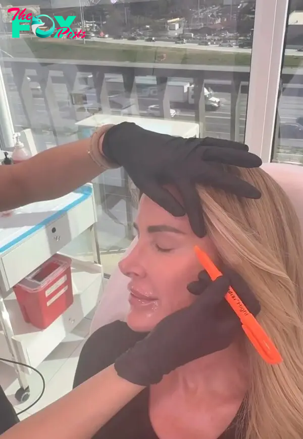 Kim Zolciak getting Botox and lip injections