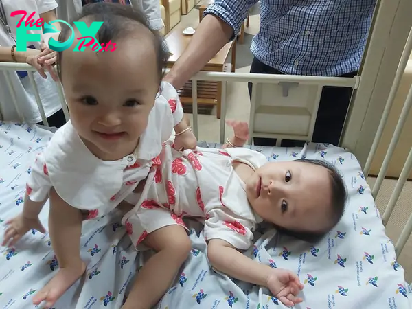 Phẫu thuật hai bé sinh đôi dính nhau