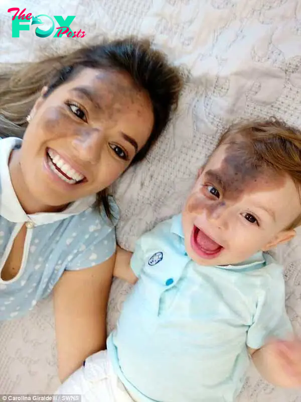 When he was just five-days-old Enzo had to undergo surgery to check the birthmark was harmless