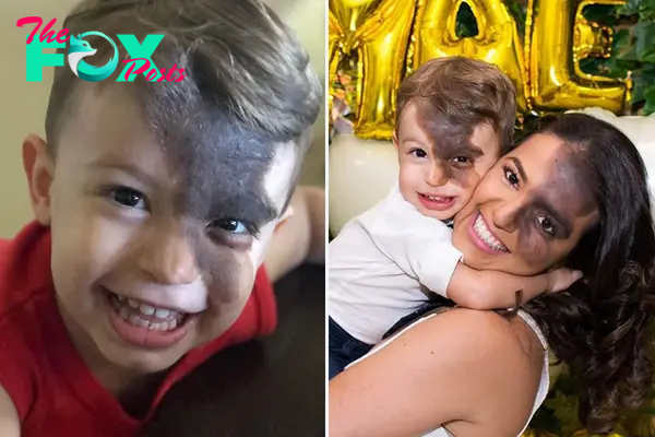 Societal Judgement Towards Enzo's Mark On His Face Encouraged His Mom To Replicate It On Hers To Walk In His Shoes | Bored Panda