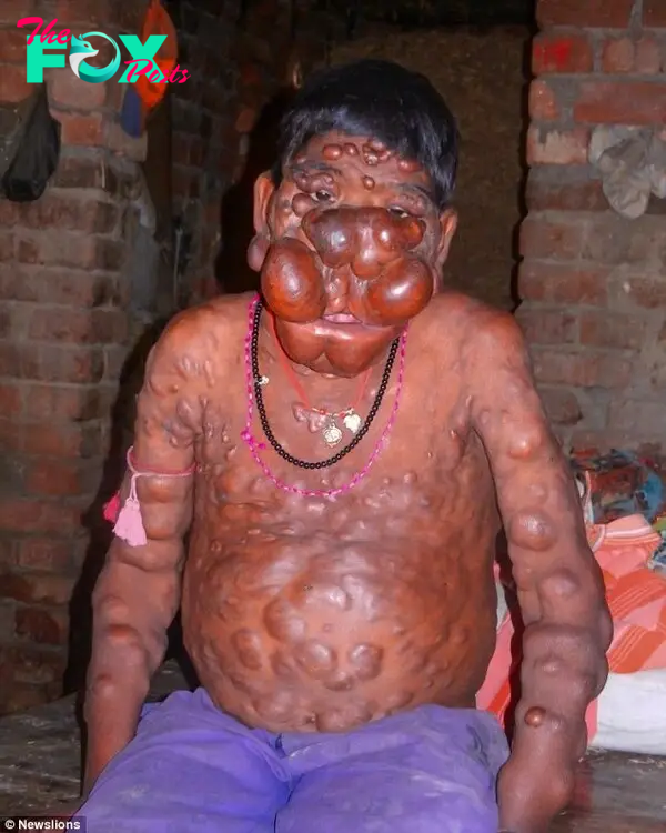 Mithun suffers from neurofibroma syndrome, which causes tumors to grow all over his body.