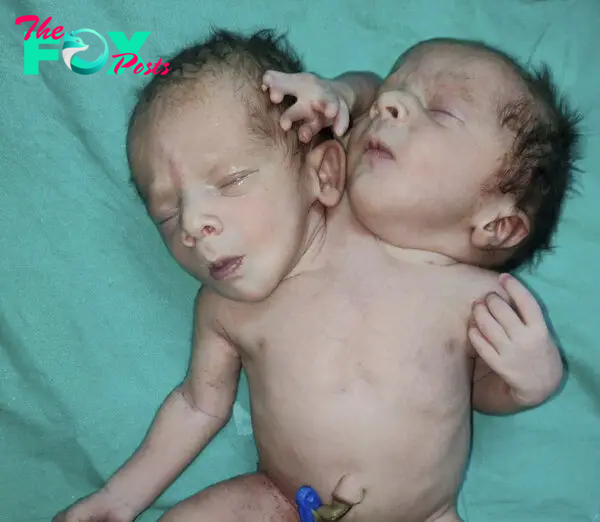 Baby born with two heads, three hands, and two hearts in Madhya Prades, India
