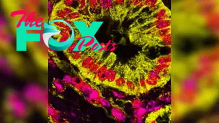 Multi-colored stained microscope image of cancerous cells in the pancreas. The cells are a yellow-green color and their mitochondria are pink. The background is black