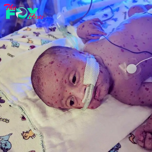  The tot is covered in red birthmarks, not related to his other health problems, his parents discovered