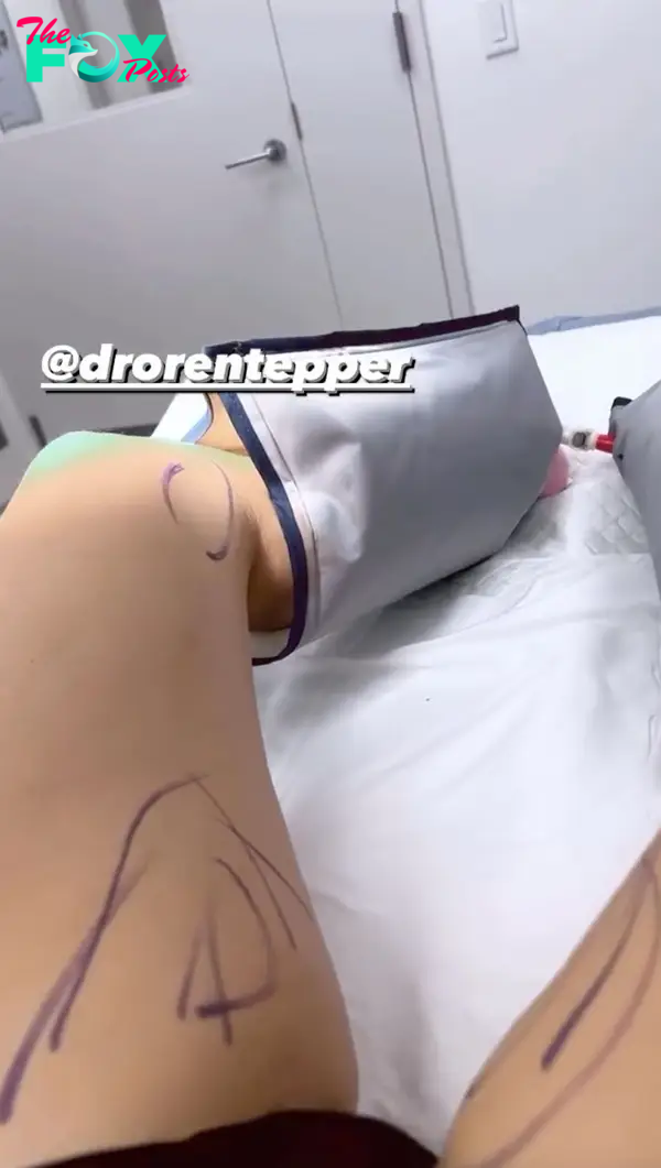 picture of jenny mollen's leg marked up