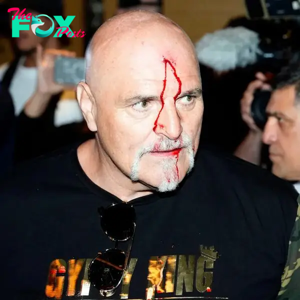 During the media day, before the fight between the British and the Ukrainian, Fury’s father ended up with a bloody head after an altercation.