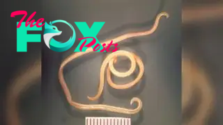 A photo of the roundworm that causes the parasitic infection Toxocariasis.