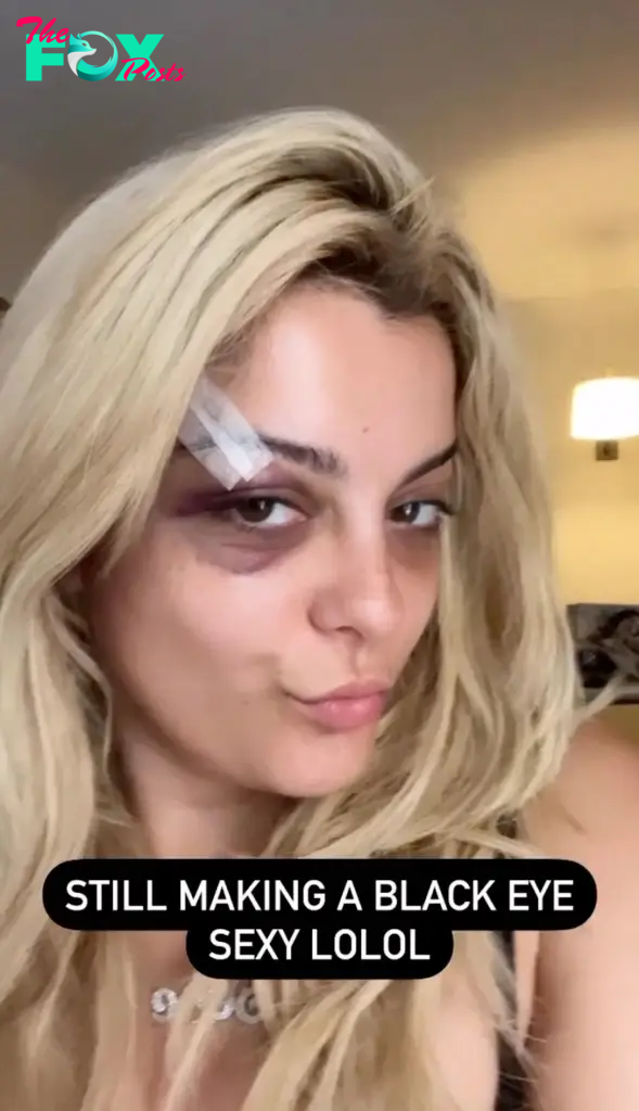 Bebe Rexha with a black eye. 