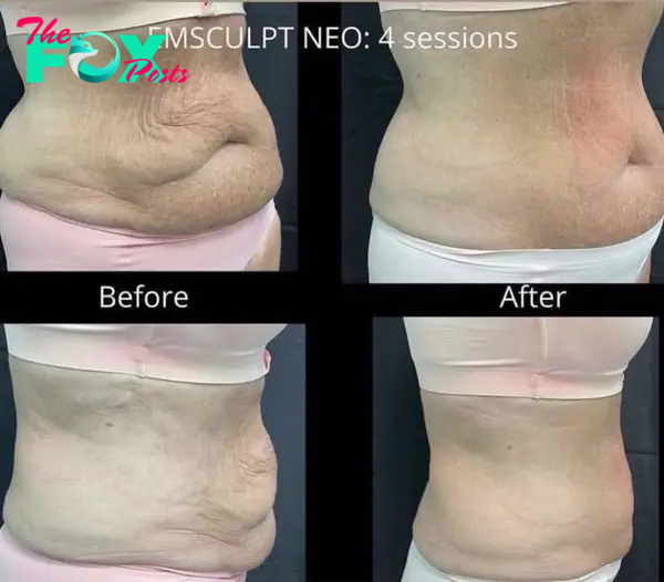 EmSculpt NEO results