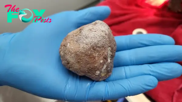 A large bladder stone is in the palm of a surgeons had for scale. They are wearing a blue rubber glove.