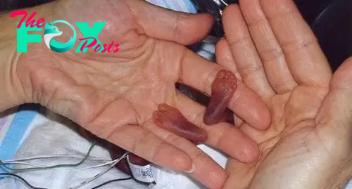 Interesting story, the world's smallest baby girl, born only 25 cm