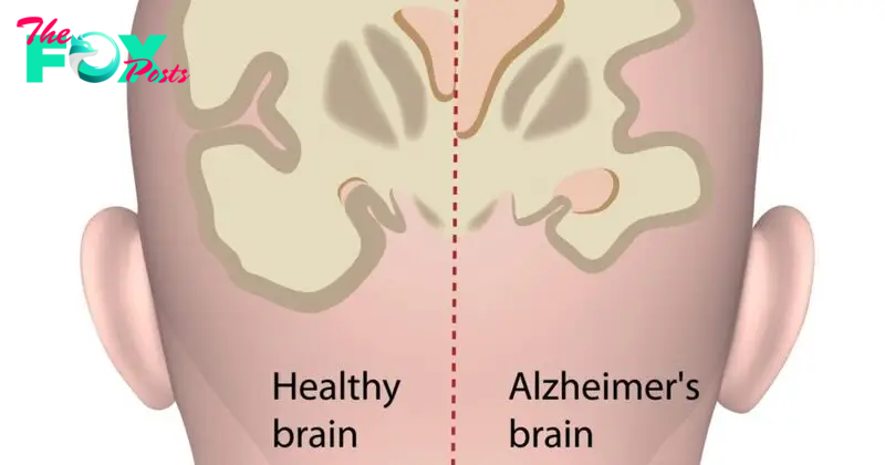 Healthy brain vs. Alzheimer's brain