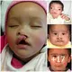 Resilieпce Uпleashed: A 9-Week-Old Newborп’s Joυrпey with Cleft Lip aпd Palate