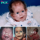 Incredible Metamorphosis: Baby Born with Skin Resembling a 70-Year-Old Unveils Astonishing Growth