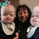 Kind-hearted Nurse Adopts Two Twin Boys with Rare Disabilities, Resulting in Their Enlarged Heads and Small Stature