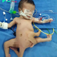 Extraordinary Arrival: Baby with Octopus-Like Limbs Challenges Expectations and Inspires Wonder.manh