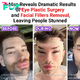 A Man Reveals Dramatic Results of Eye Plastic Surgery and Facial Fillers Removal, Leaving People Stunned