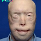 Patrick Hardison received a new face after third-degree burns, this is him today