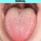 What White Tongue Is, and What to Do About It