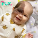 Parents’ Love Drives Them to Remove Daughter’s Birthmark