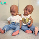 Meet Twins with the Rare Benjamin Button Syndrome, Who Became Symbols of Resilience