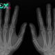 AI to aid doctors in spotting fractures on X-rays | The Express Tribune