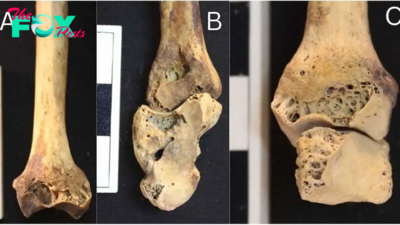 3,500-year-old burial of Nubian woman reveals 1 of world's earliest known cases of rheumatoid arthritis