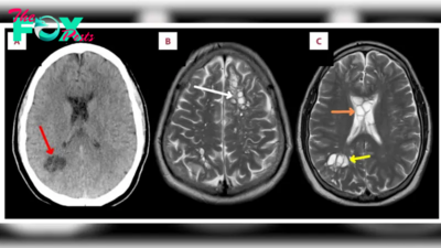 Parasitic worms found in man's brain after he likely ate undercooked bacon