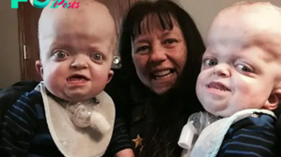 Kind-hearted Nurse Adopts Two Twin Boys with Rare Disabilities, Resulting in Their Enlarged Heads and Small Stature