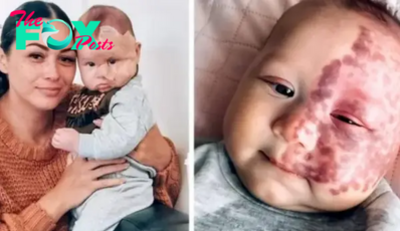 The Real Reason a Mother Decided to Get Rid of Her Son’s Birthmark with a Laser Sparks Criticism – PHOTOS