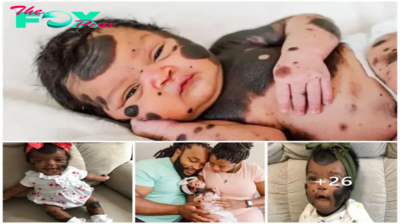 STB “A Rare Disease Causes Black Spots All Over Newborn Girl’s Body, Prompting Emotional Reactions”. STB
