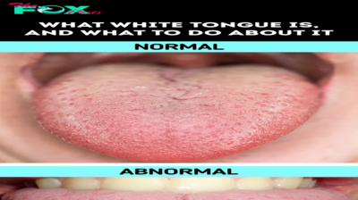 What White Tongue Is, and What to Do About It