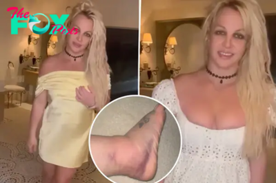 Britney Spears claims her massively swollen foot is ‘already better’ after it was ‘broken’ at Chateau Marmont