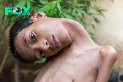 SN Indian Boy Has Life-Changing Surgery and Sees the World Straight for the First Time SN