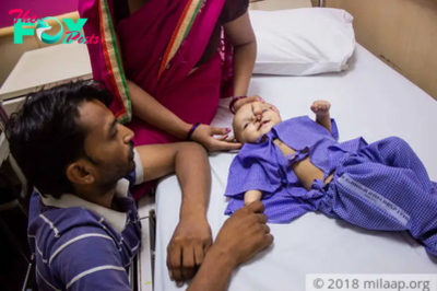 Defying all odds: Life-changing surgery to restore Indian girl’s nasal deformity, overcoming adversity.