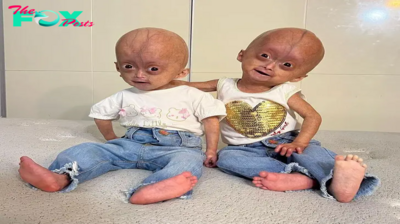 Meet Twins with the Rare Benjamin Button Syndrome, Who Became Symbols of Resilience