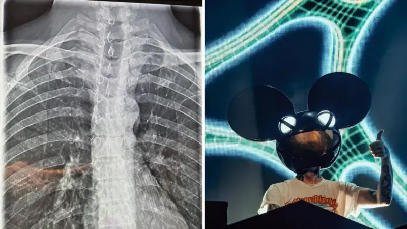 DJ’s shocking X-ray of spinal issue sparks heavy costume concerns