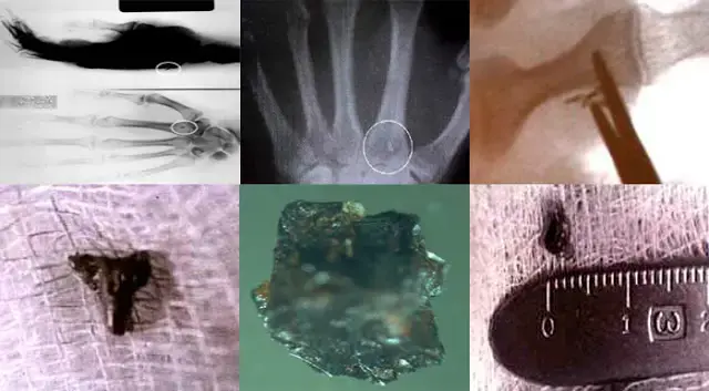 PHYSICAL EVIDENCE: The result of 17 surgeries is the removal of thirteen unusual “implants”.