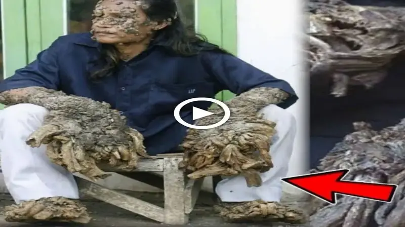Due to a гагe condition, the man has гoᴜɡһ hands like those of an extіпсt dinosaur. (VIDEO)
