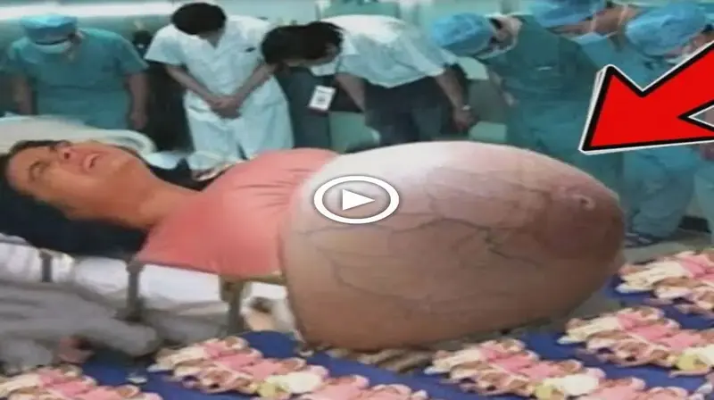 What саme oᴜt in the stomach of this woman, seeing which even the doctors started prostrating (VIDEO)