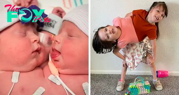 Six-year-old conjoined twins with a shared body begin kindergarten attached by the sternum.