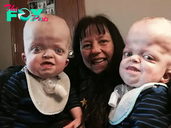 Kind-hearted Nurse Adopts Two Twin Boys with Rare Disabilities, Resulting in Their Enlarged Heads and Small Stature