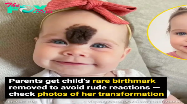 ’’We Got Stares’’, Parents Choose to Remove Baby Girl’s Rare Birthmark to Avoid Rude Reactions