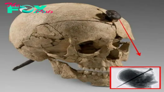 Unveiling History’s Mystery: Iron-Nailed Skull of a Young Ancient Warrior Discovered