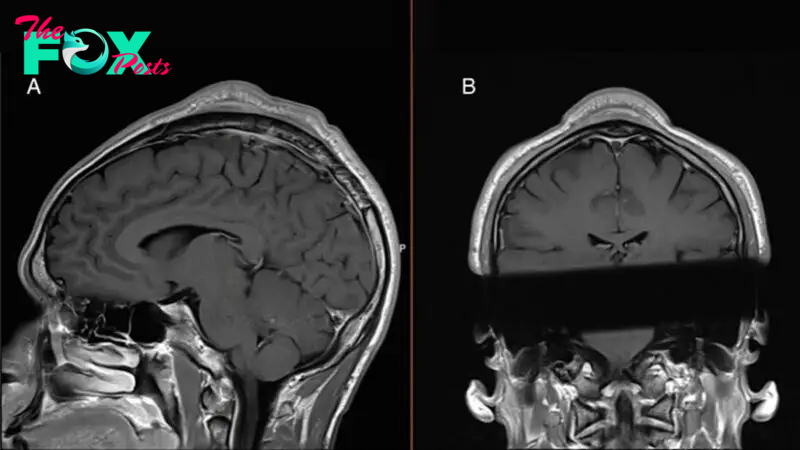 Man developed a 'headspin hole' after years of breakdancing, case report says